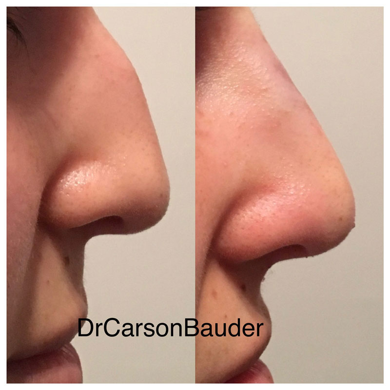 Non-surgical-rhinoplasty-2-5d92248ed204d